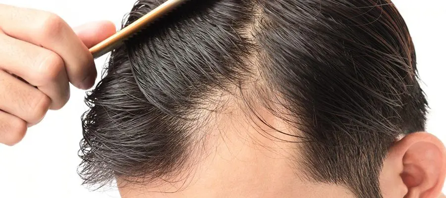 WHO CAN HAVE A HAIR TRANSPLANTATION?